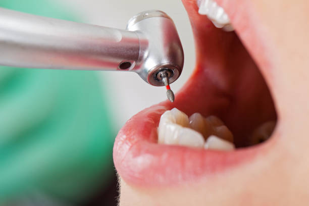 Best Emergency Dental Care for Broken or Chipped Teeth in New Hartford Center, CT